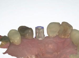 dental impressions - ios impression