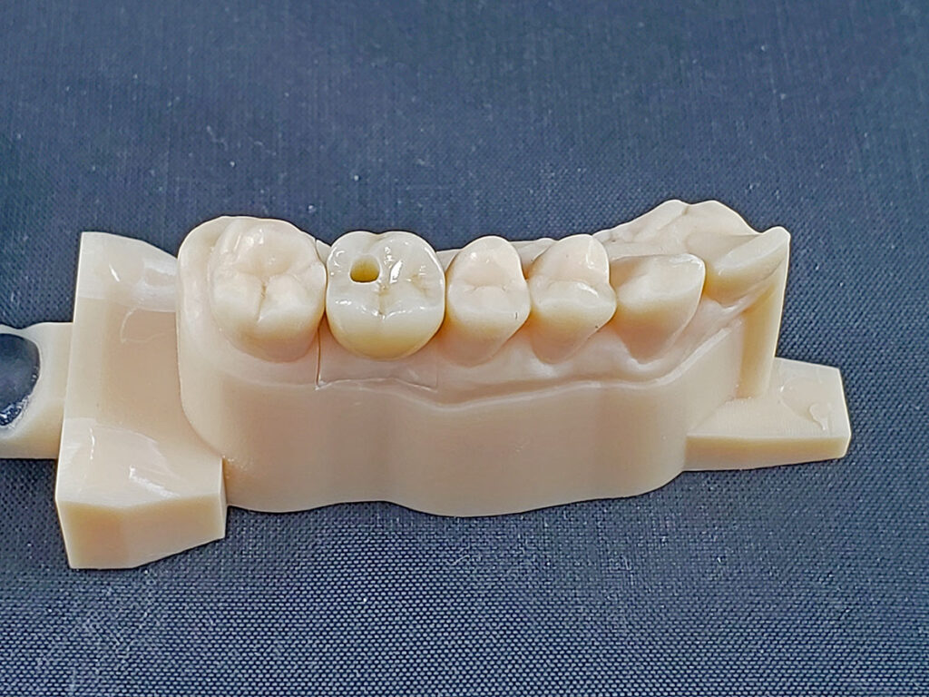 zirconia dental restoration